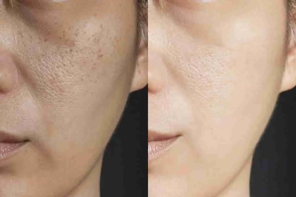 Microneedling vs Chemical Peel: Which is Better?